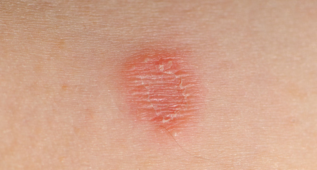 Wrestling Hygiene: Keeping Athletes on the Mat