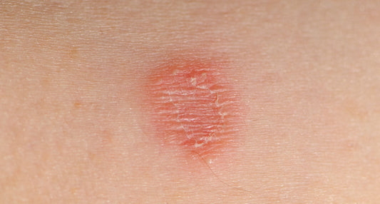 Wrestling Hygiene: Keeping Athletes on the Mat